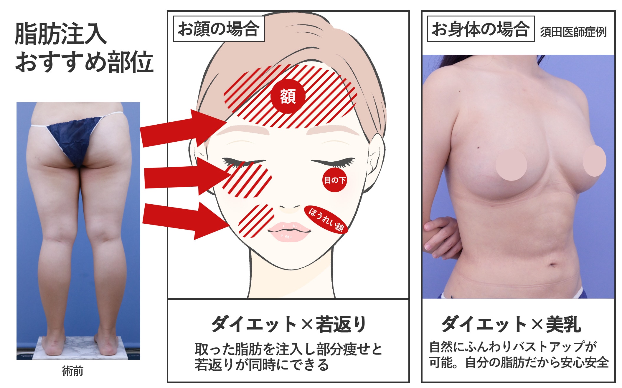 取った脂肪を再利用♪人気の脂肪注入部位