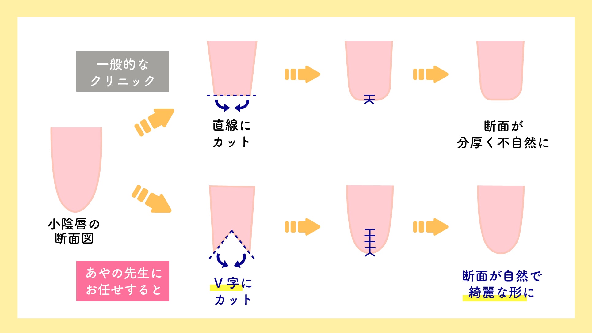 最大限仕上がりを綺麗に。あやの先生こだわりの『オリジナルV字カット法』