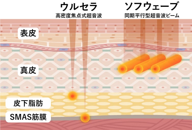 たるみの原因