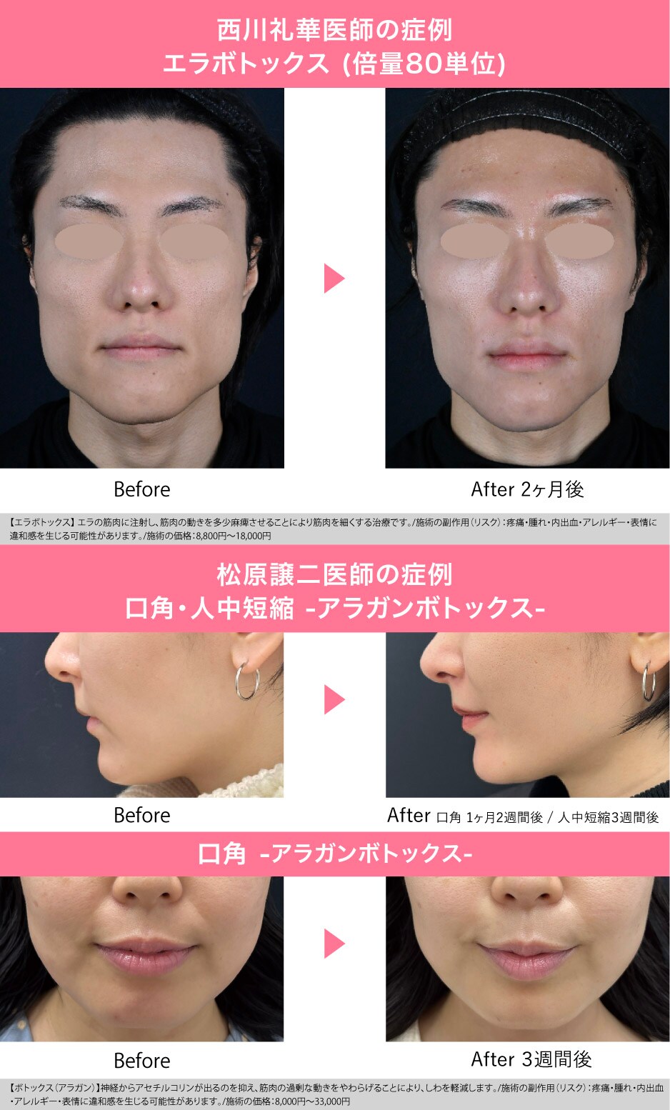 表情筋への繊細なアプローチ”ボトックス”