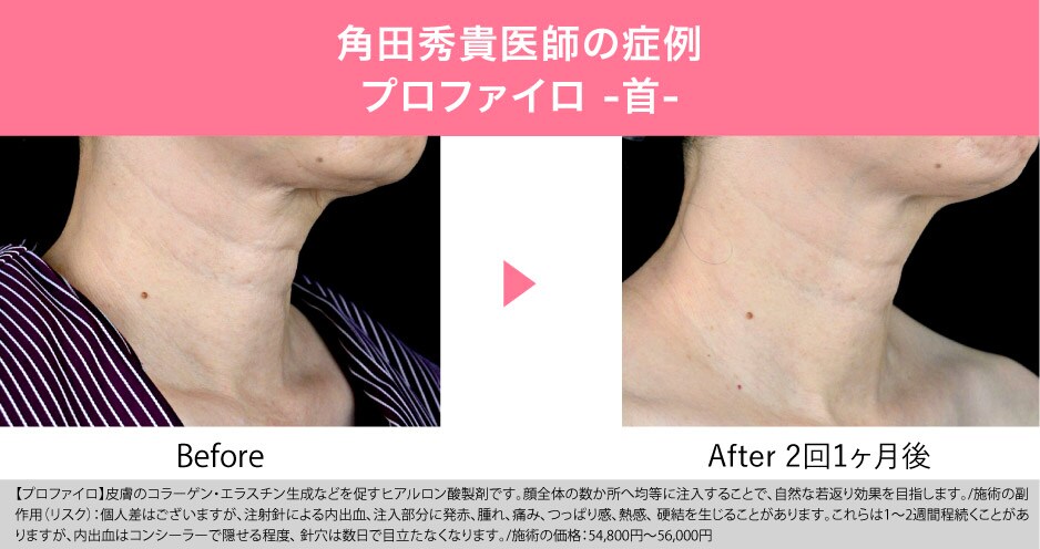 肌細胞の再構築！次世代ヒアルロン酸の”プロファイロ”！