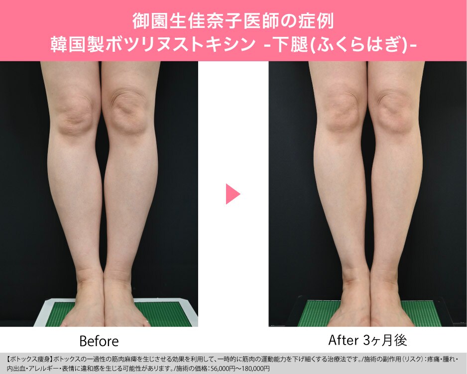”痩身ボトックス”で脱・筋肉質な脚！