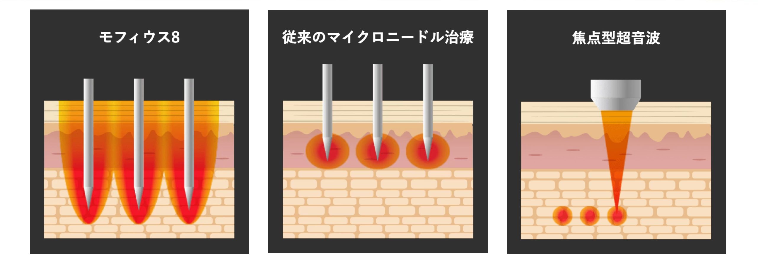 モフィウス8（マイクロニードルRF）と他の施術の違いを比較