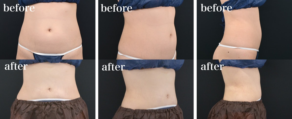 before/after