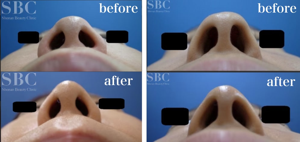 before/after