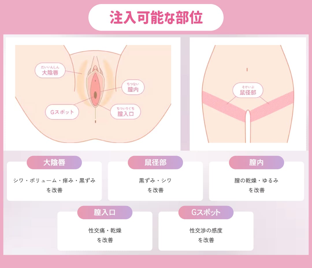 注入できる部位について
