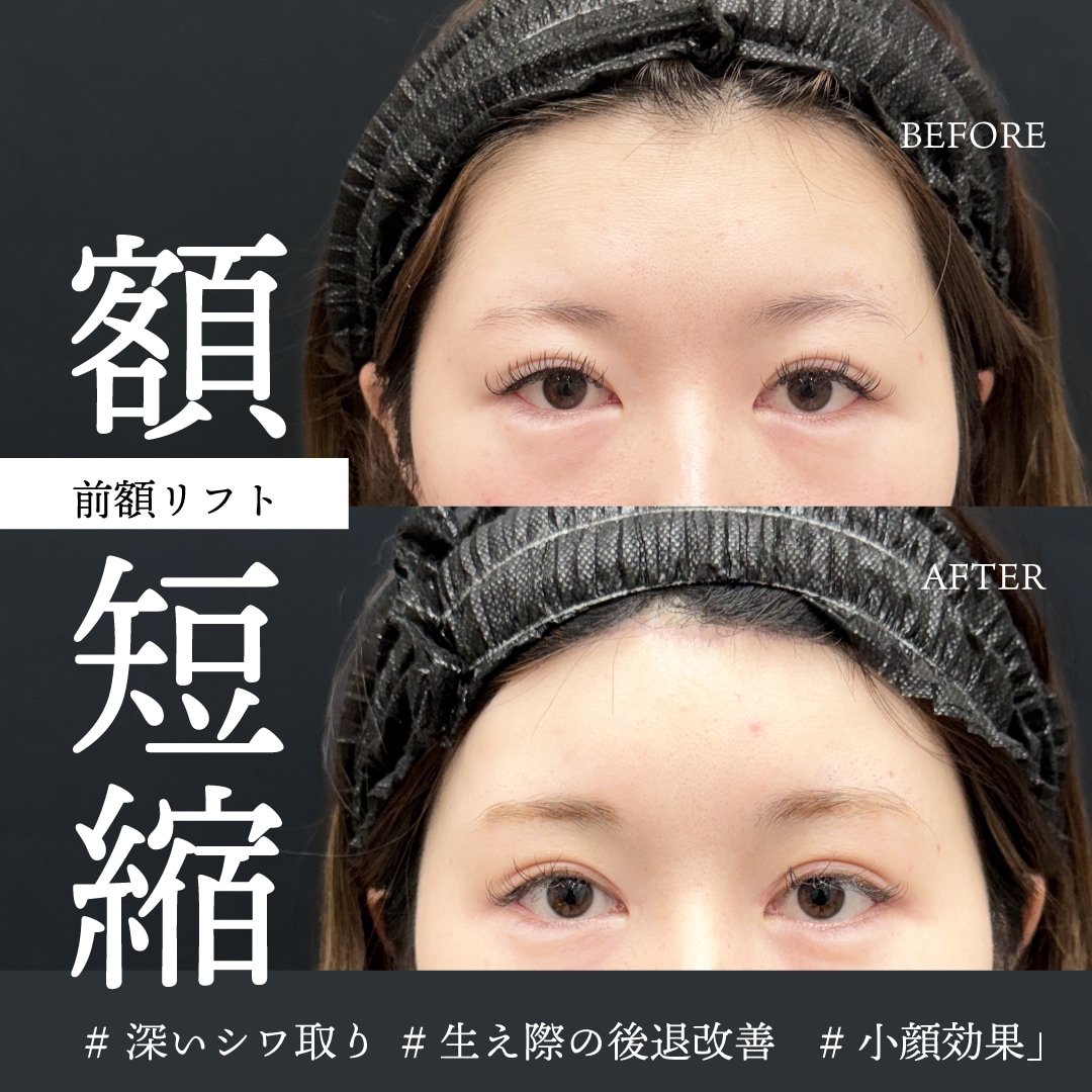 シワ改善・小顔・目元のたるみ改善｜超長期的な改善治療