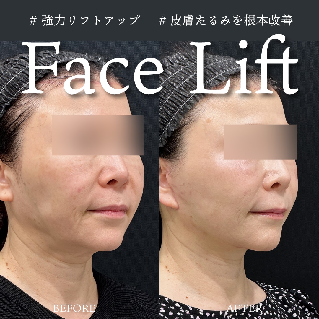 たるみ改善｜筋膜から根本を引き上げる「切開リフト」