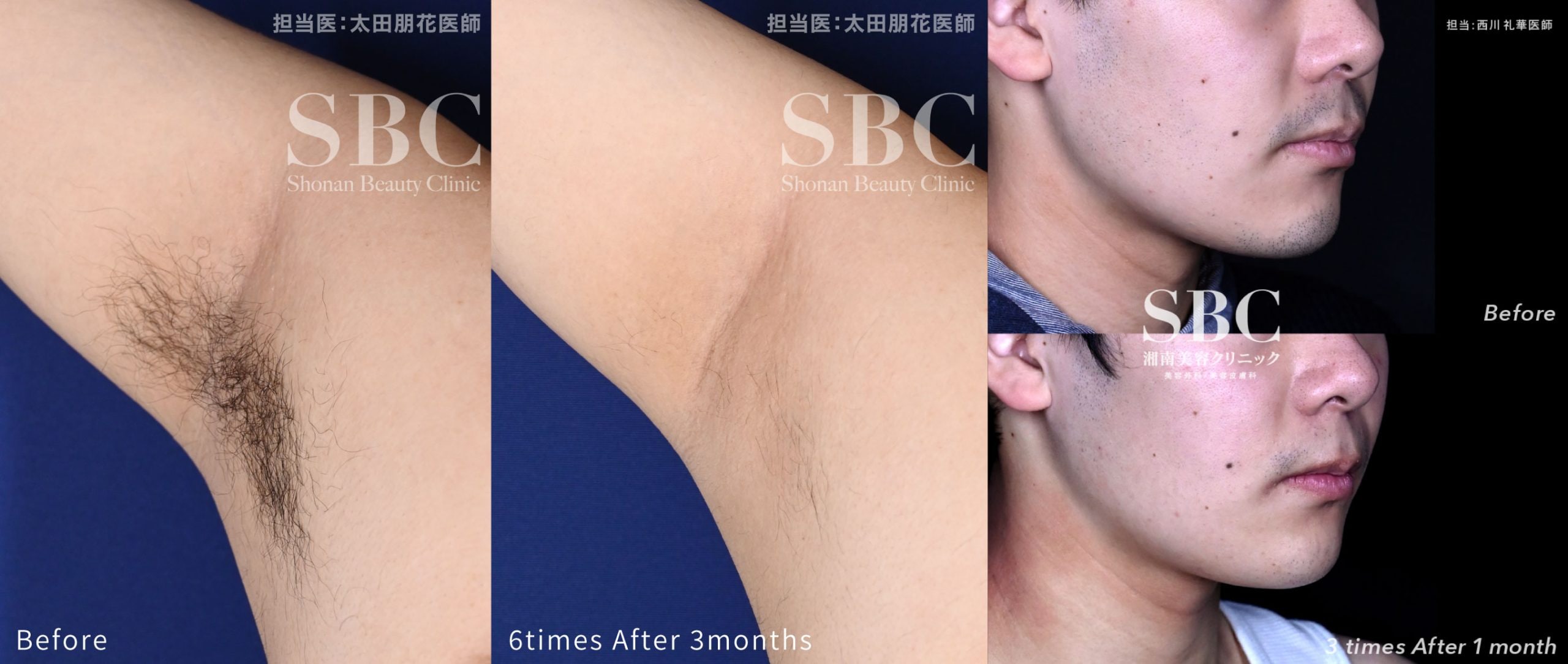 メンズ医療脱毛