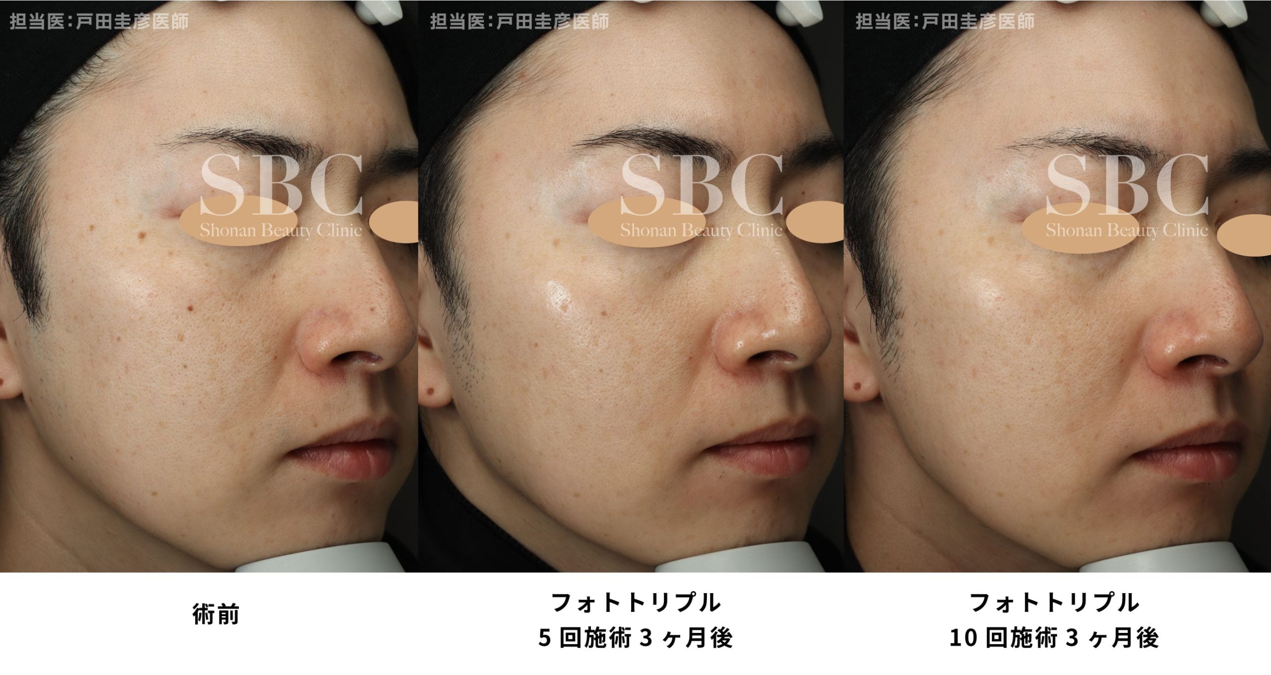 メンズシミ取り
