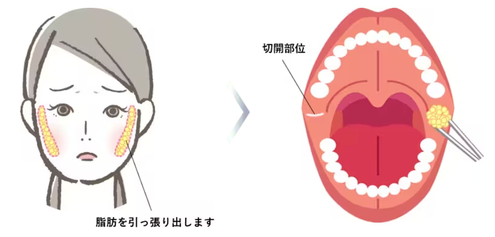 お口のもたつきが気になるなら『糸＋バッカルファット除去』