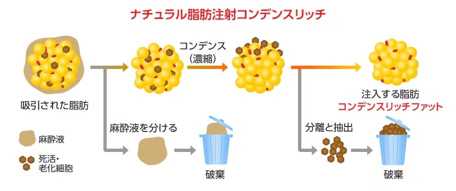 コンデンスリッチ脂肪注入