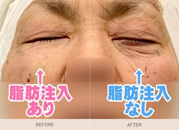 目元のシワも同時に改善できる！