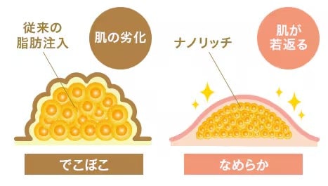 ナノリッチ脂肪注入