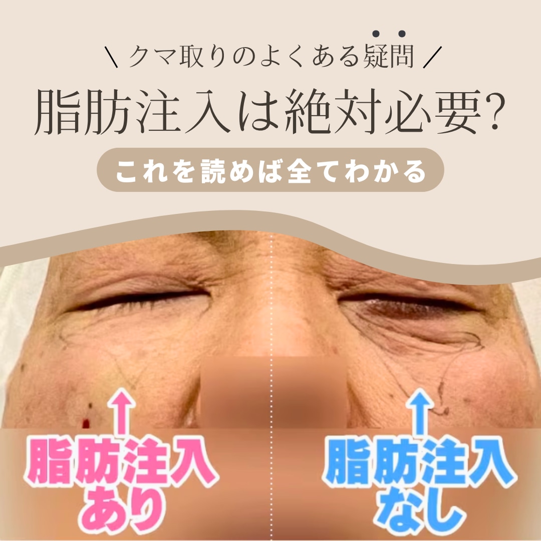 【疑問】クマ取りはなんで脱脂だけじゃダメなの？失敗しないための脂肪注入併用の知識📚