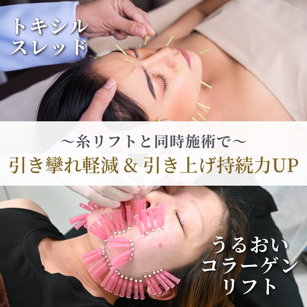 【たるみも美肌もWで叶える💫】最強の組み合わせ治療❣️『糸リフト＋ショートスレッド』