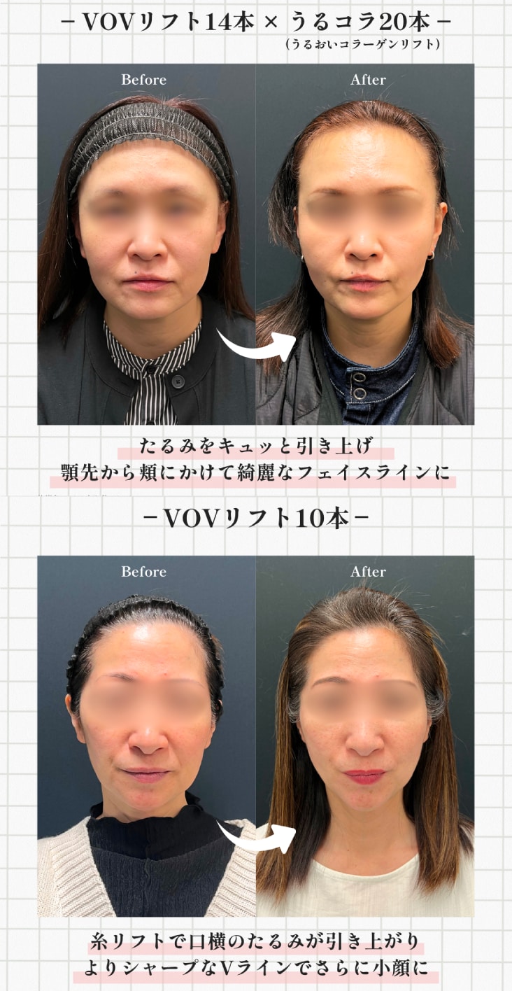 VOVリフト症例