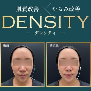 新百合ヶ丘でデンシティ（DENSITY）｜切らないたるみ治療を駅直結で