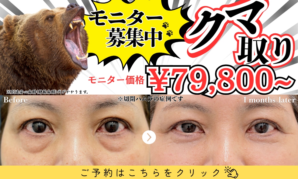 【モニター募集中】形成外科専門医によるクマ・たるみ治療🐻