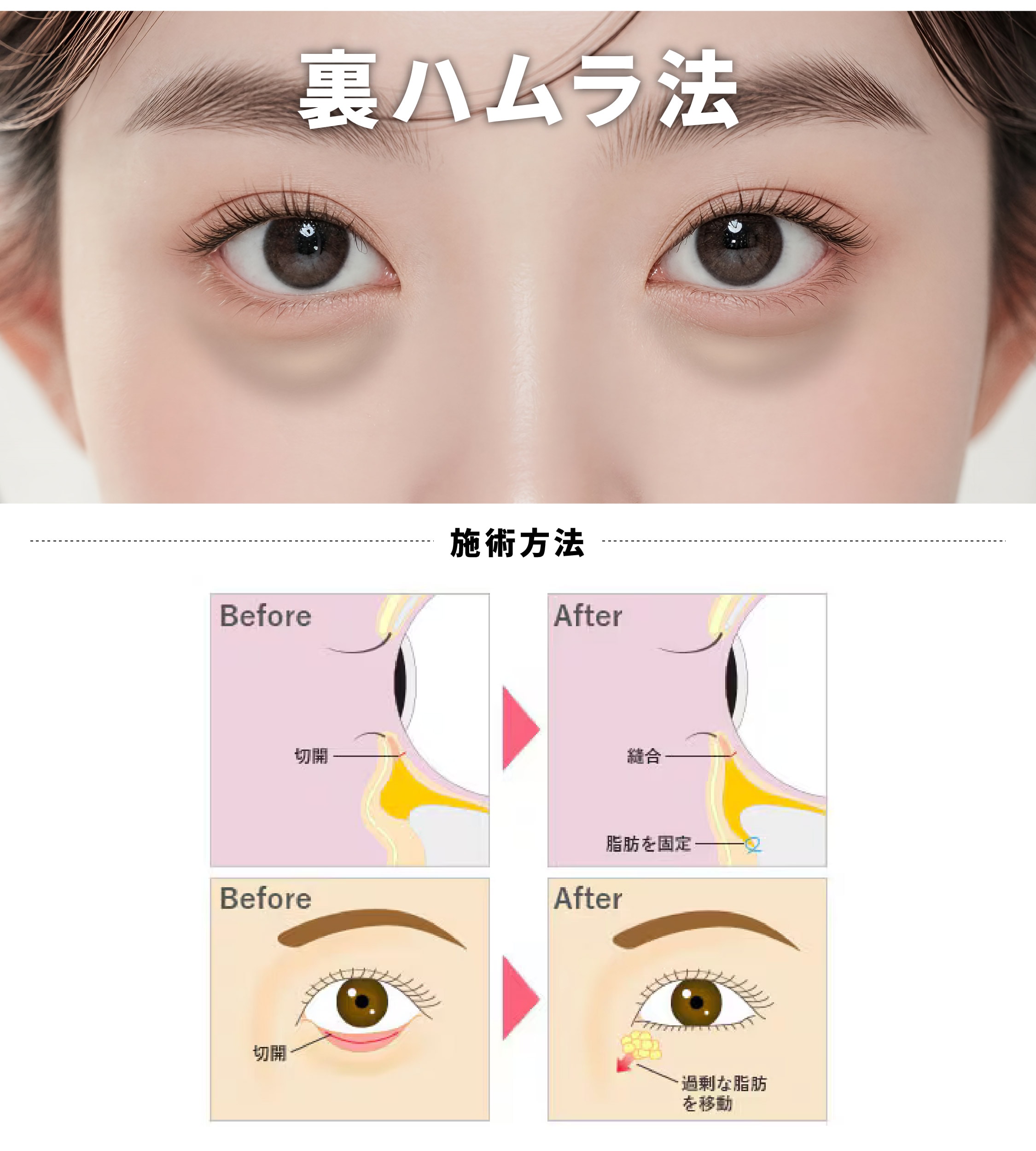 裏ハムラ法