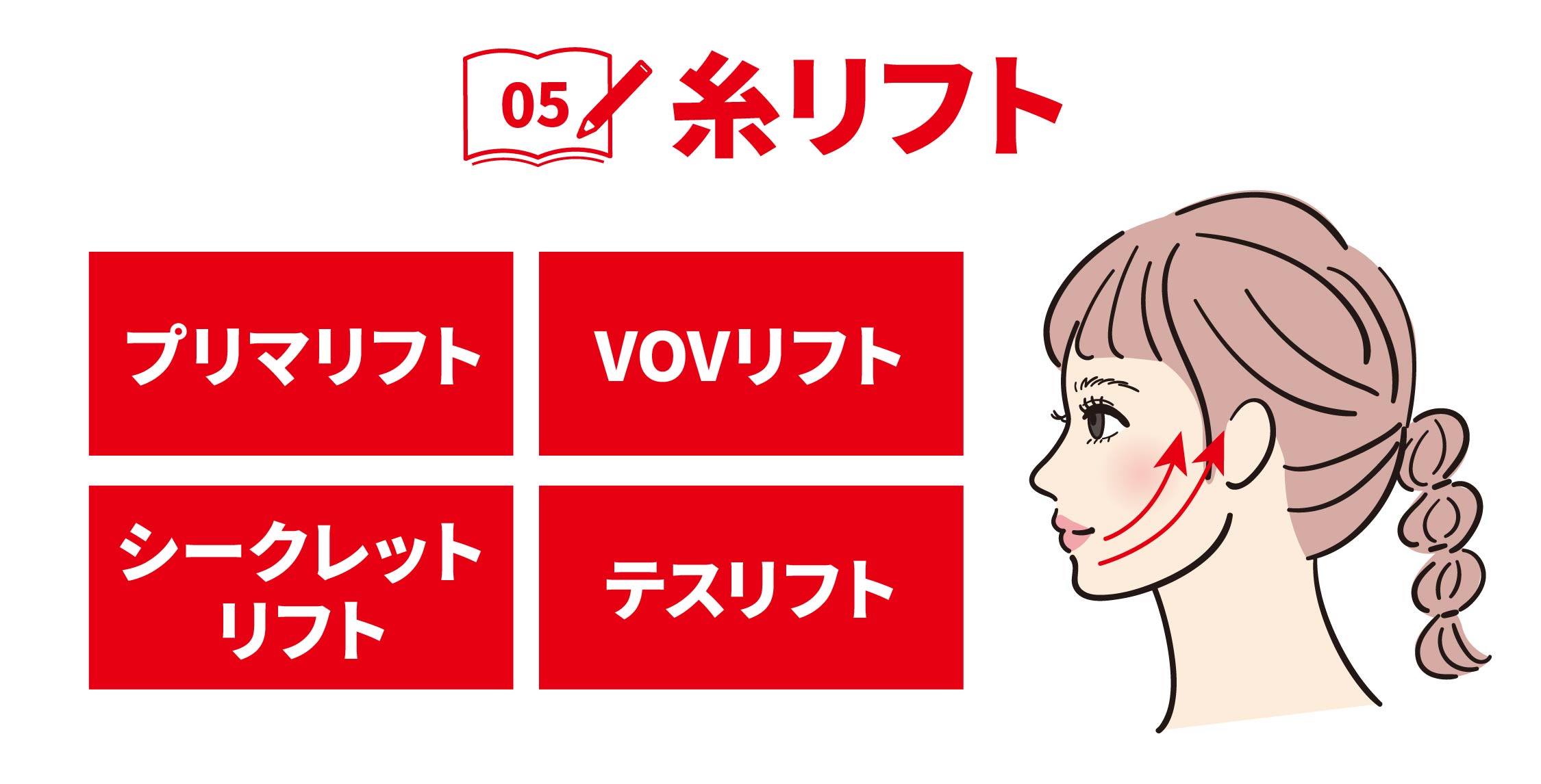 糸リフト