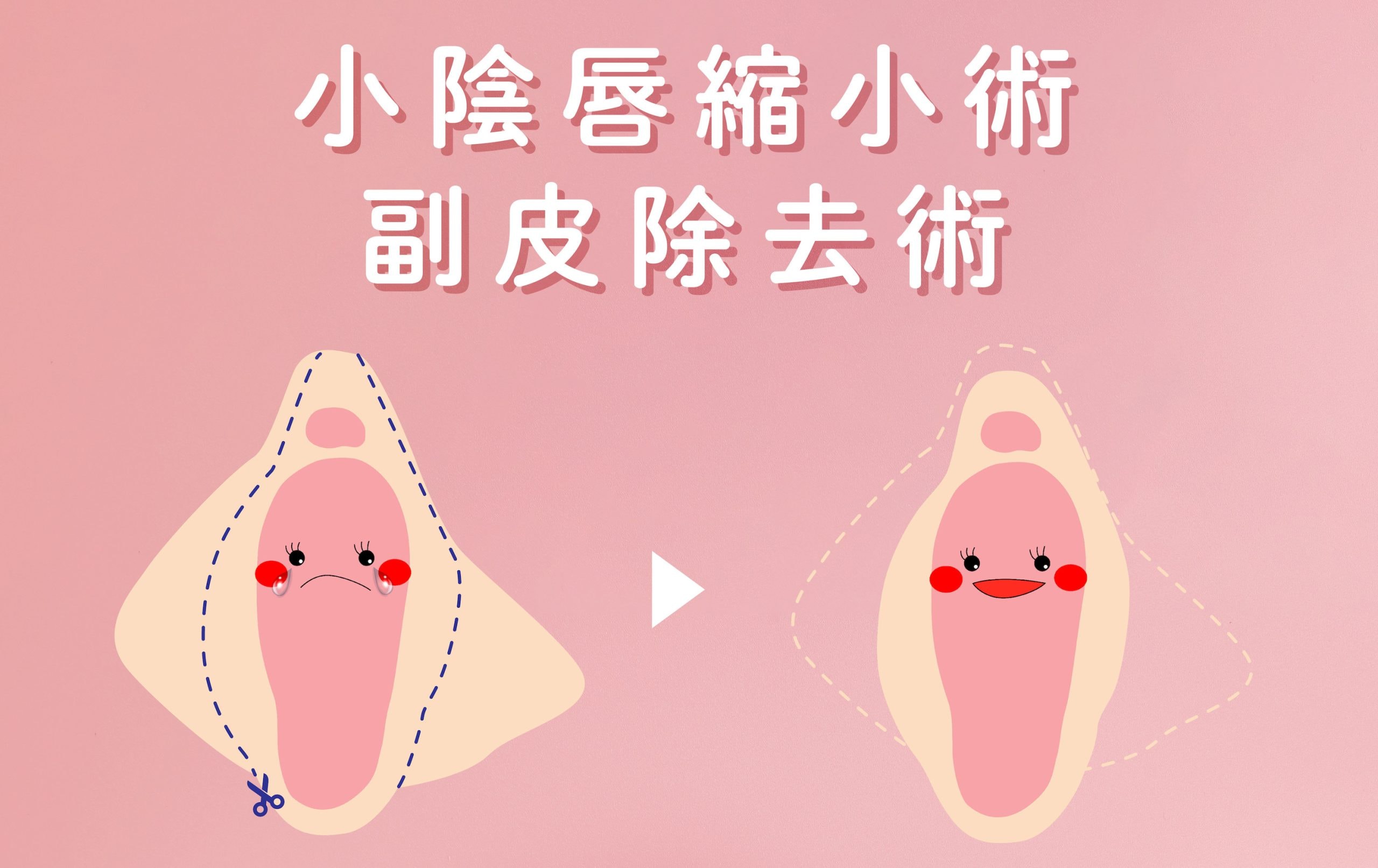 小陰唇縮小術&副皮除去術