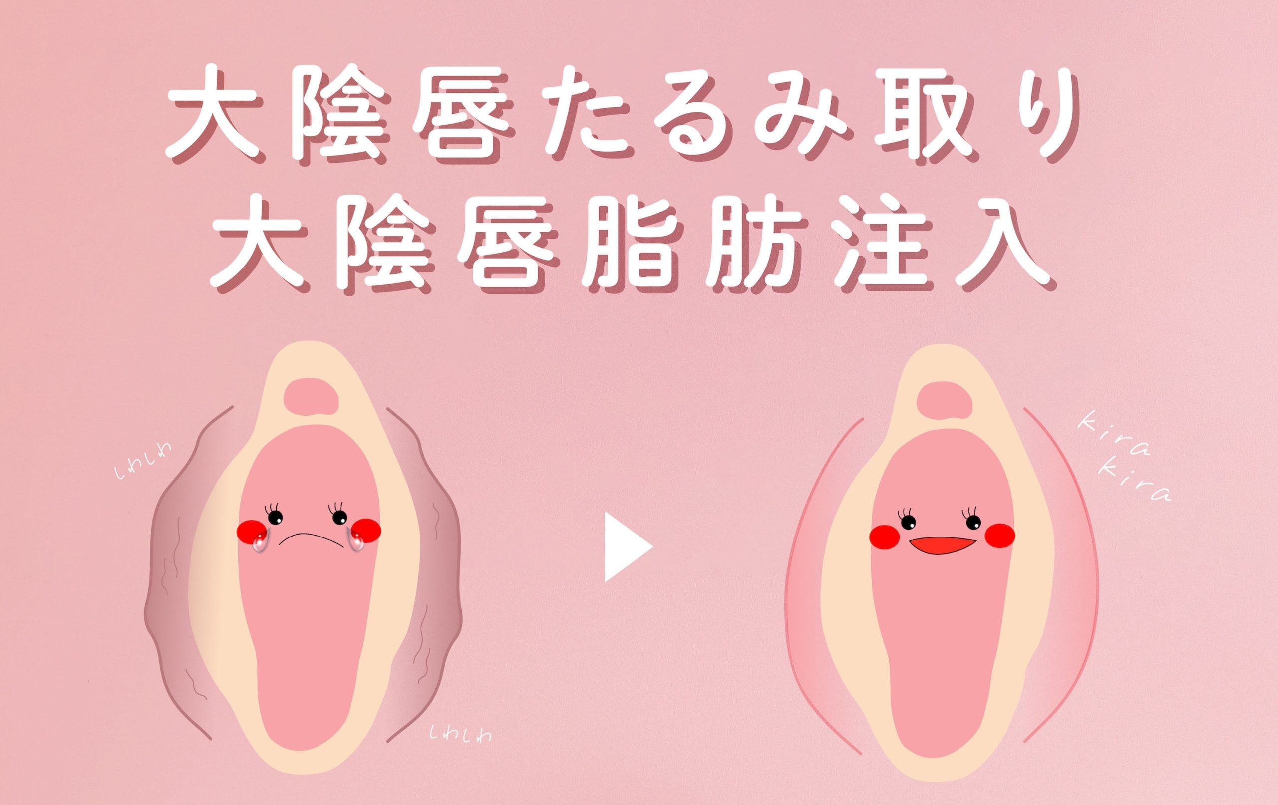 大陰唇たるみ取り&大陰唇脂肪注入