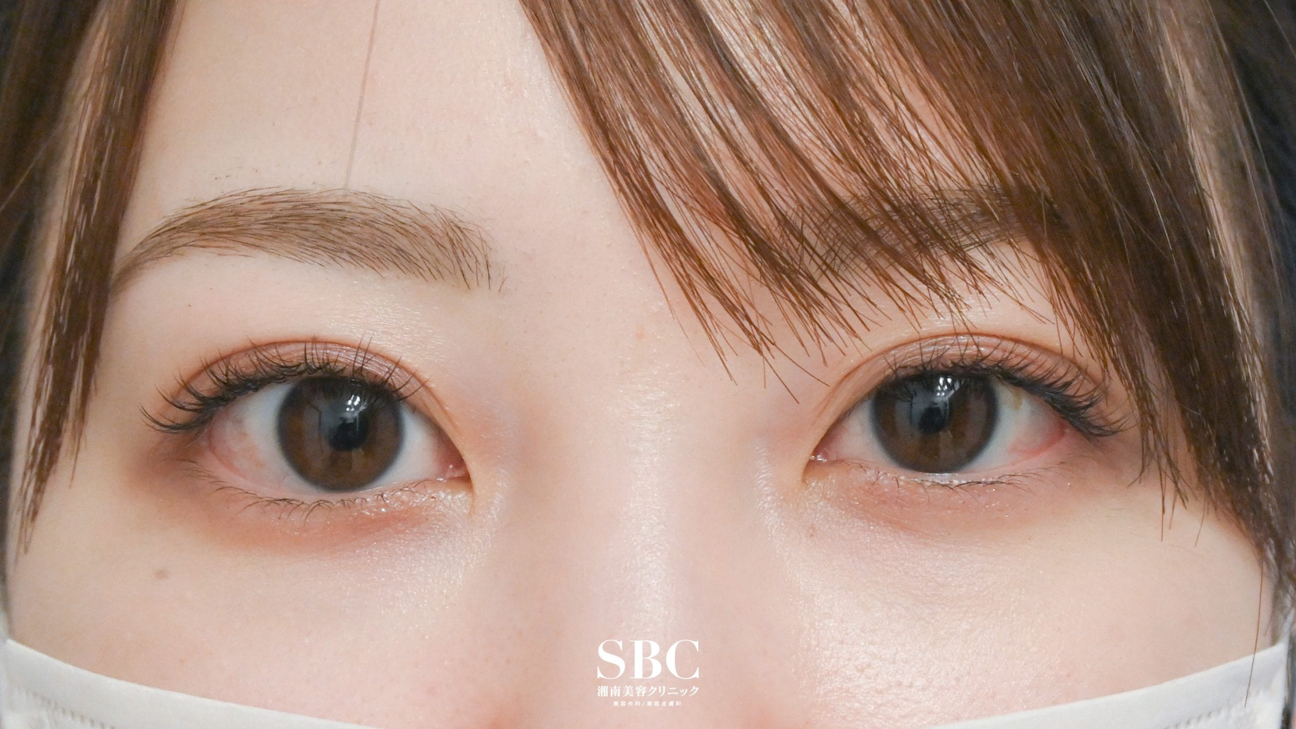 {クイックコスメティーク・ダブルNeo} {20代}  {女性} の術後の症例写真