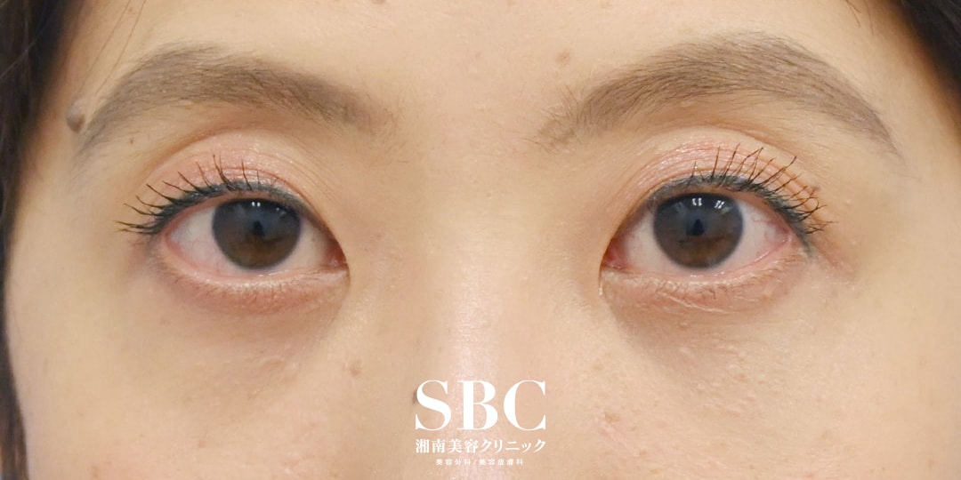 {目の下のクマ取り} {40代}  {女性} の術後の症例写真