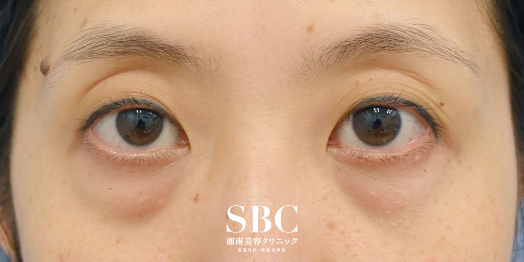 {目の下のクマ取り} {40代}  {女性} の術前の症例写真