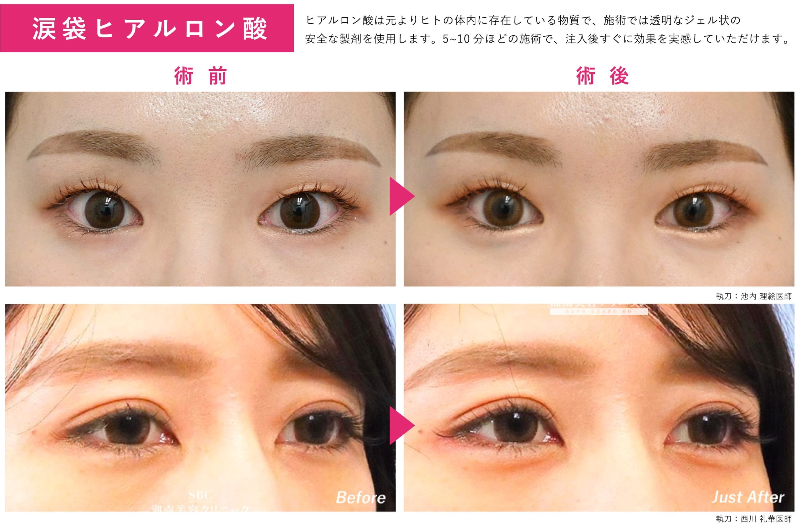 涙袋ヒアルロン酸