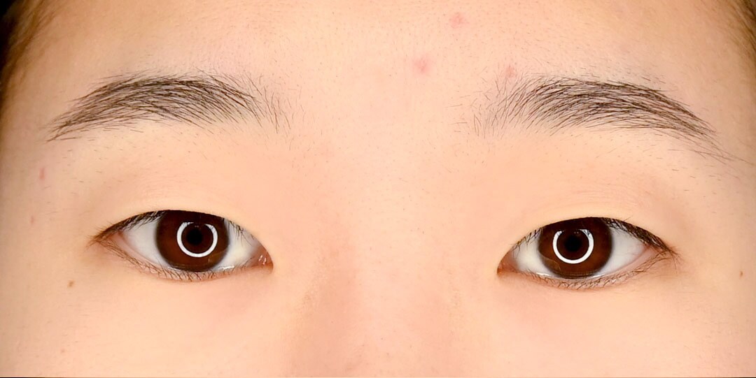 {クイックコスメティーク・ダブルNeo} {20代}  {女性} の術前の症例写真