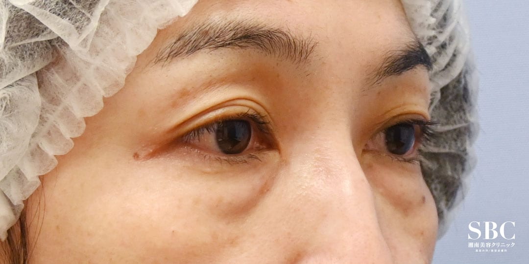 {目の下のクマ取り} {50代}  {女性} の術前の症例写真
