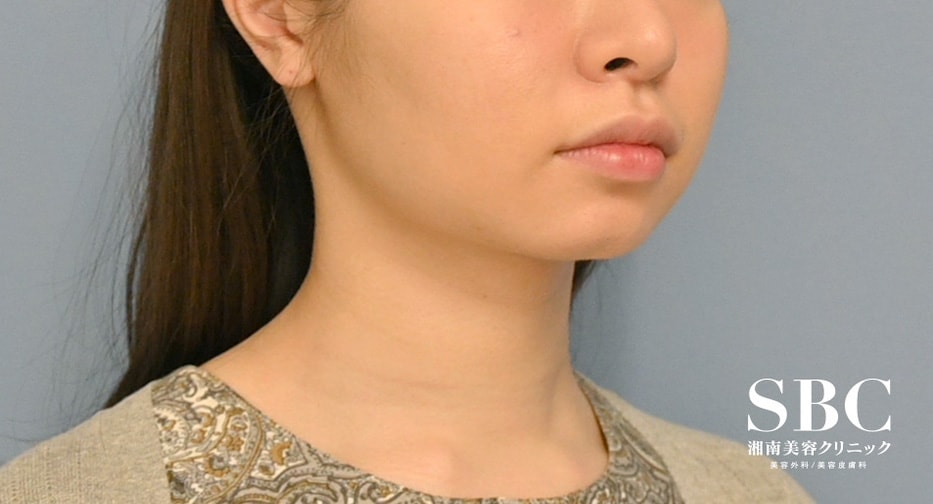 脂肪吸引・20代女性 の術後の症例写真