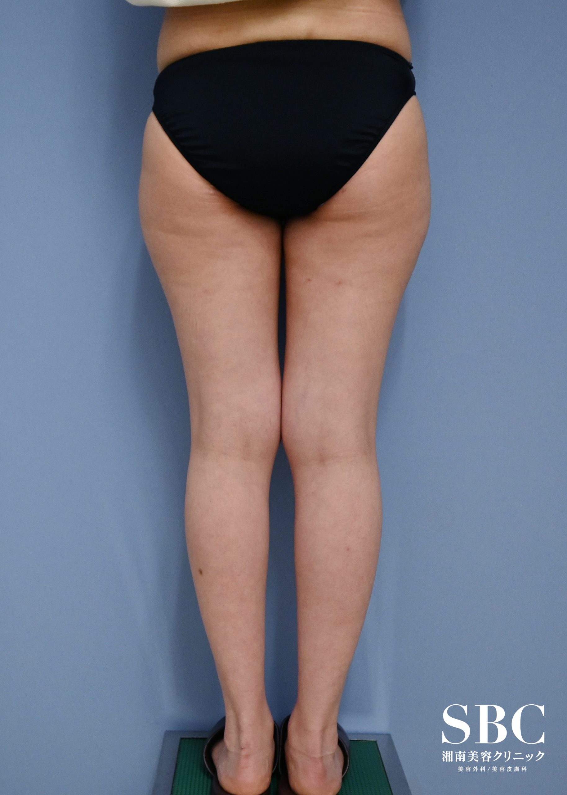 {S} {20}  {women} の術前の症例写真