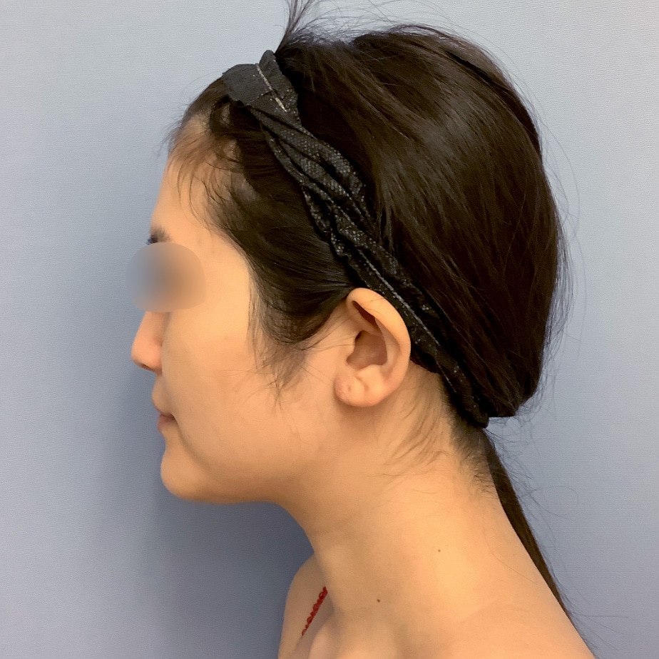 脂肪吸引・20代女性 の術前の症例写真