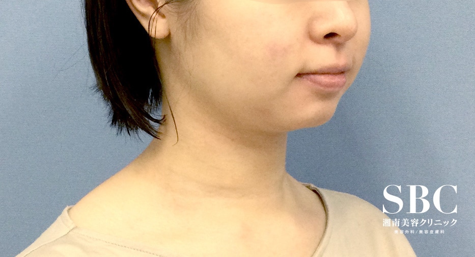 脂肪吸引・20代女性の術前の症例写真