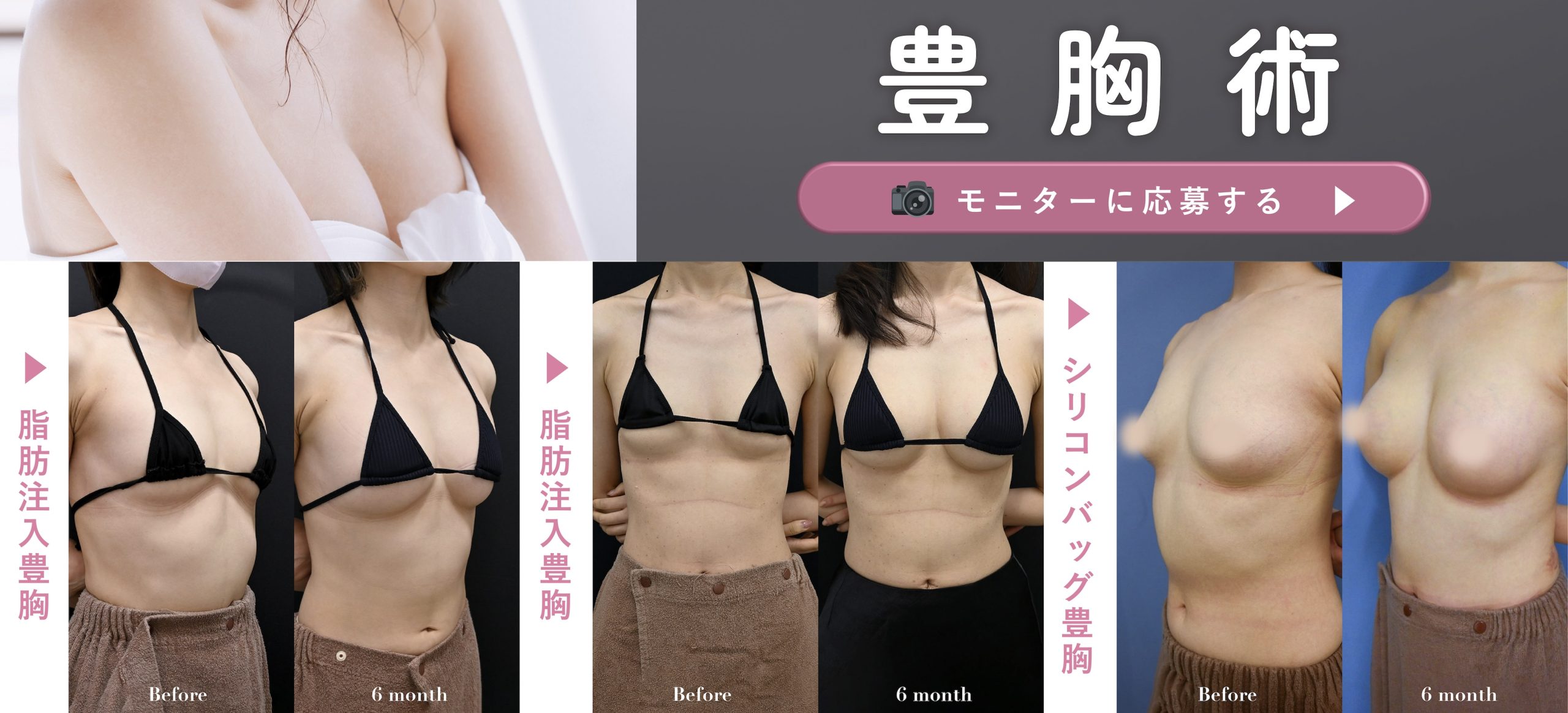 冬のおすすめNo.1🥇<br />
豊胸術