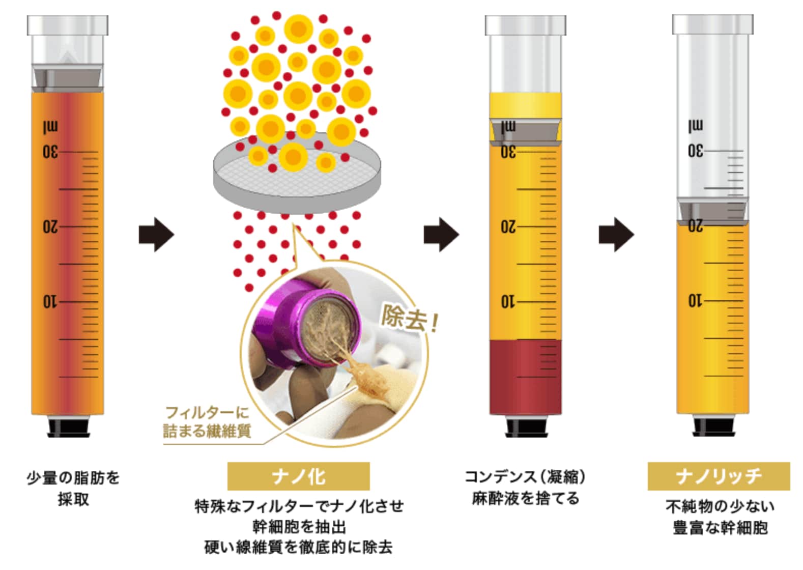 脂肪注入法〜ナノリッチフェイス〜