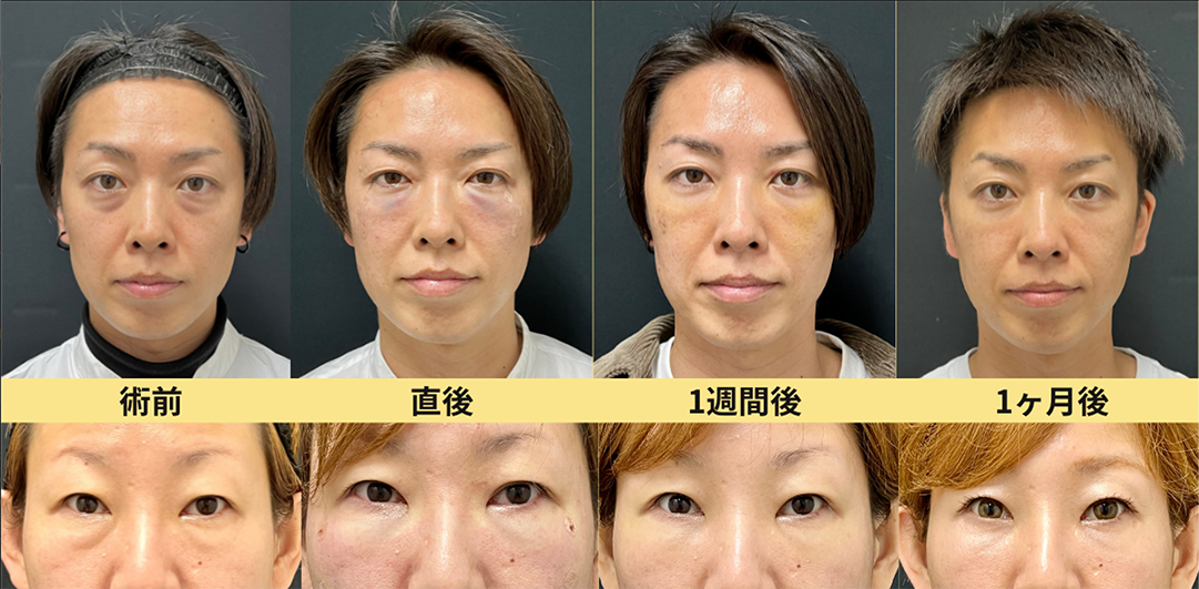 Q. ダウンタイムはどのくらいですか？仕事はいつから行けますか？