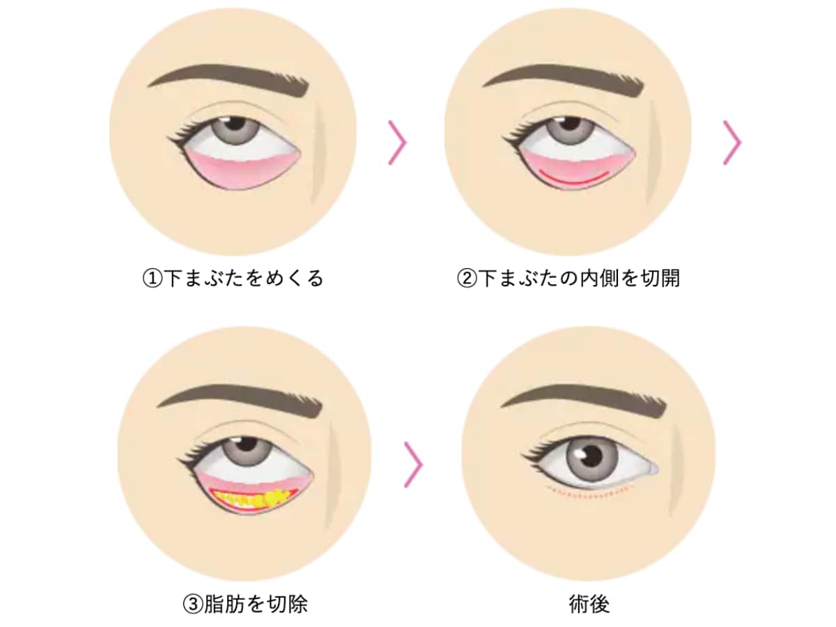 目の下の切らないクマ・たるみ（ふくらみ）取り<br />
