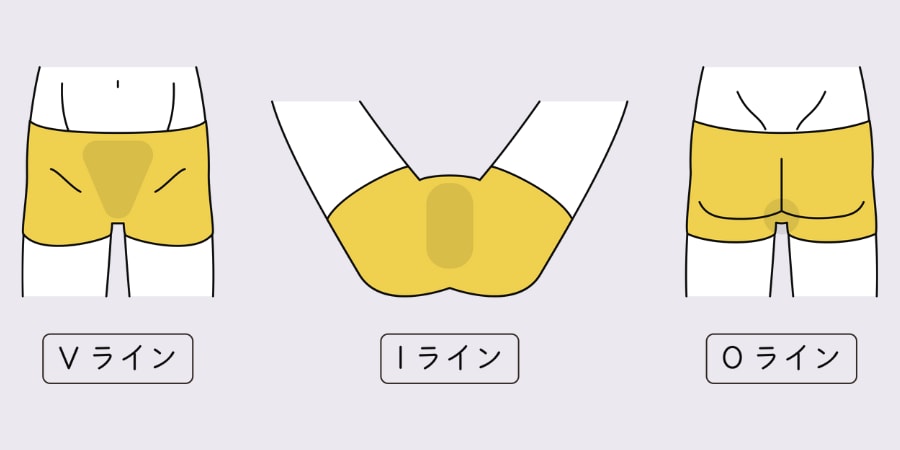 2.男性VIO脱毛