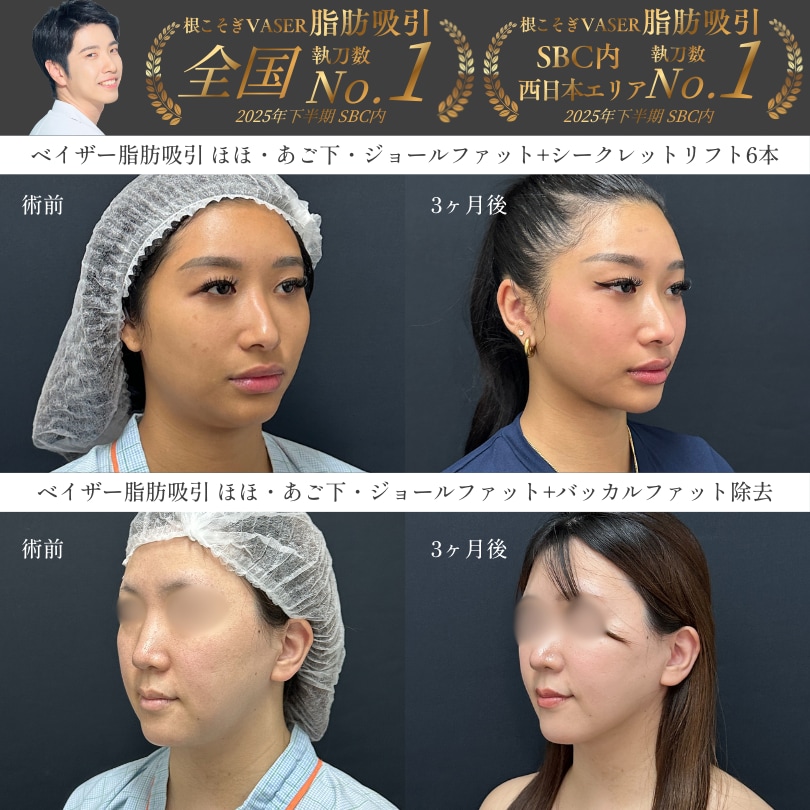 顔の脂肪吸引で写真映えする輪郭へ