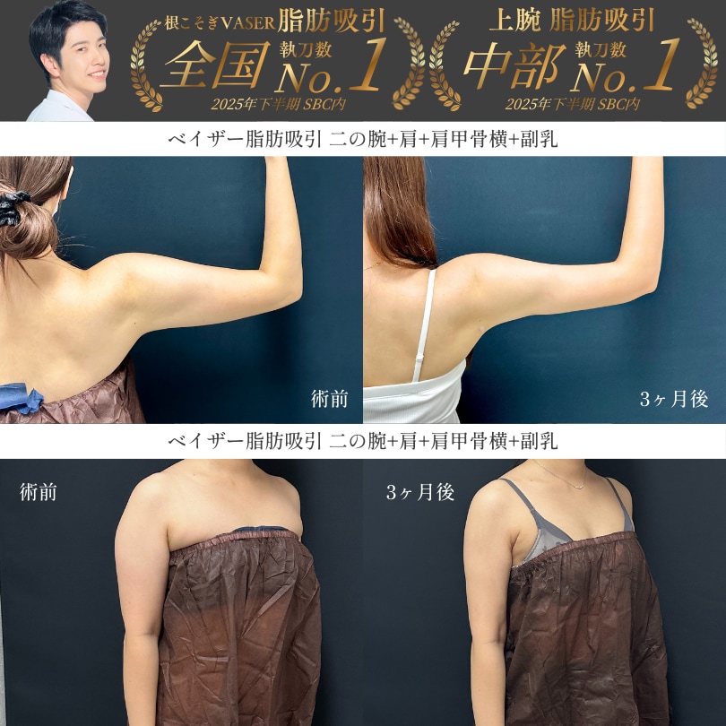 美しいドレスラインを作る二の腕脂肪吸引