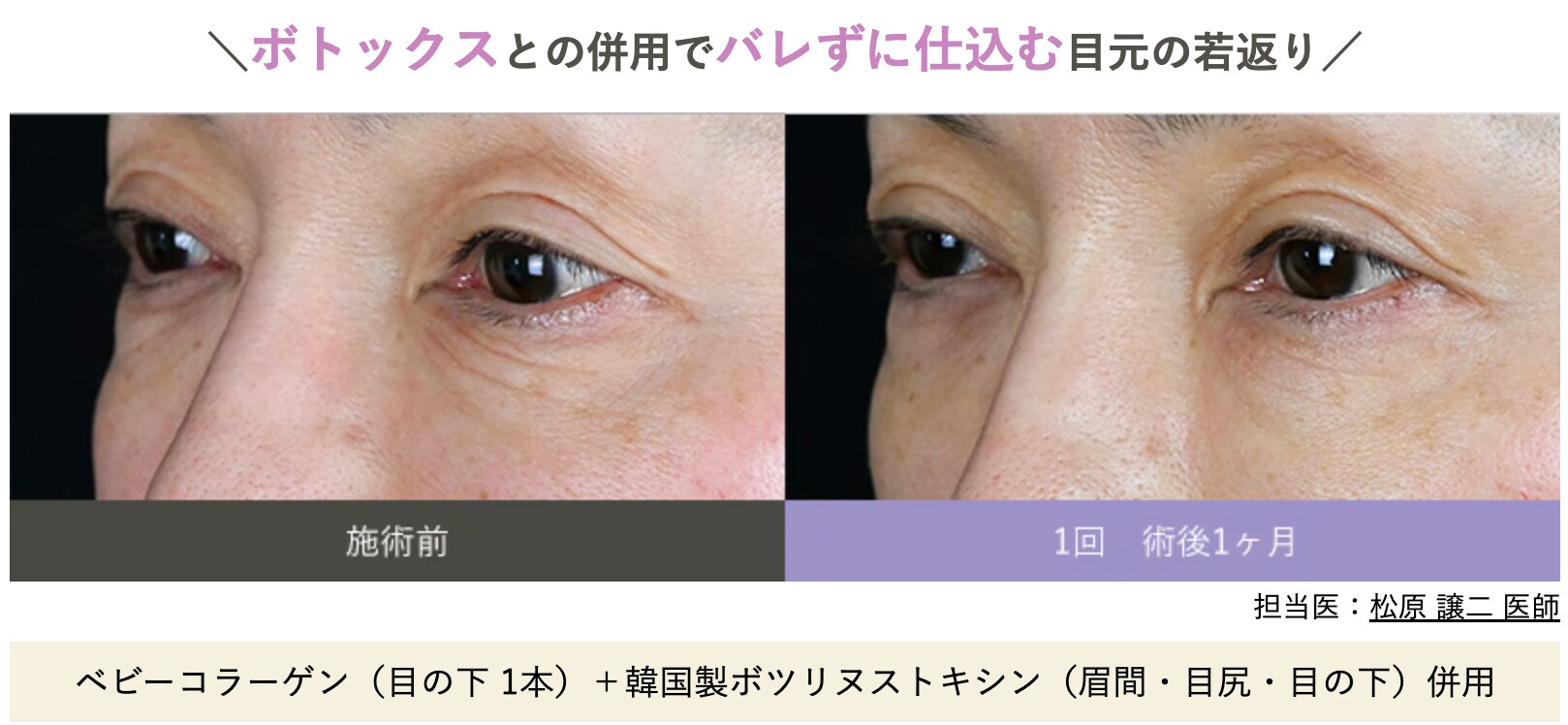 ボトックスとの併用でバレずに目元の若返り