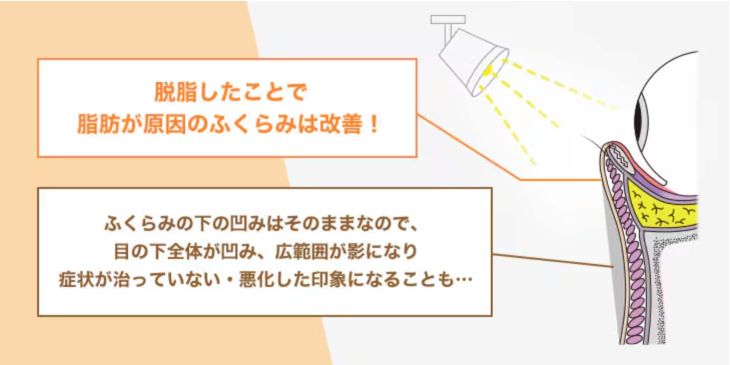 脱脂単体で起こりうる「くぼみ」や「シワ」のリスク