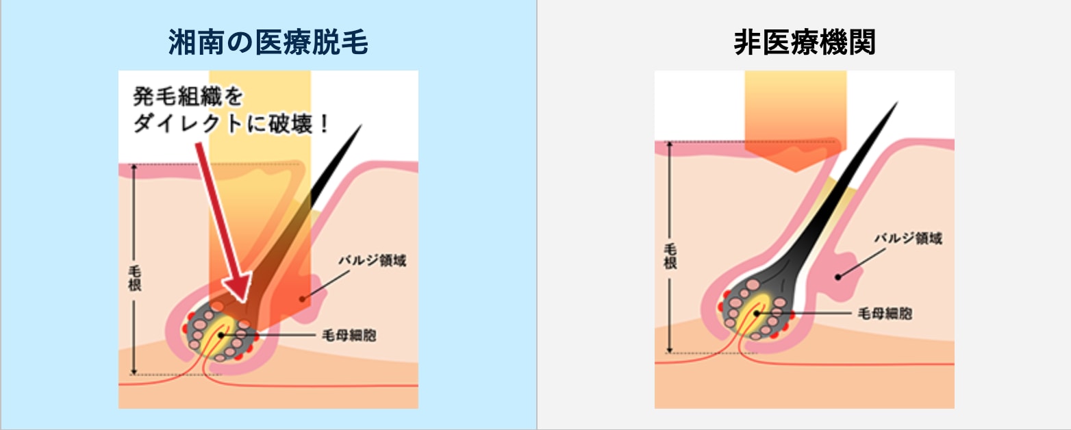 基礎知識とエステ脱毛との違い