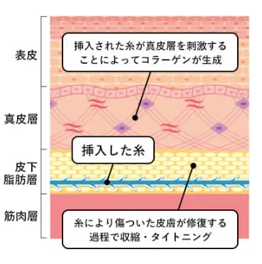 今の引き上げだけじゃない！<br />
糸リフトなら、未来のたるみも作らない。