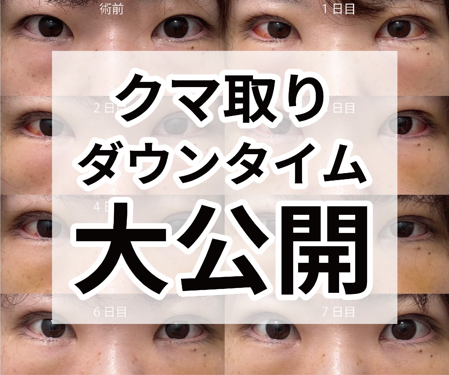 【クマ取りダウンタイム密着】新宿でクマ取り（ハムラ法）＋糸リフトするなら元心臓血管外科専門医の新宿南口院 檜山和弘院長にお任せ！！