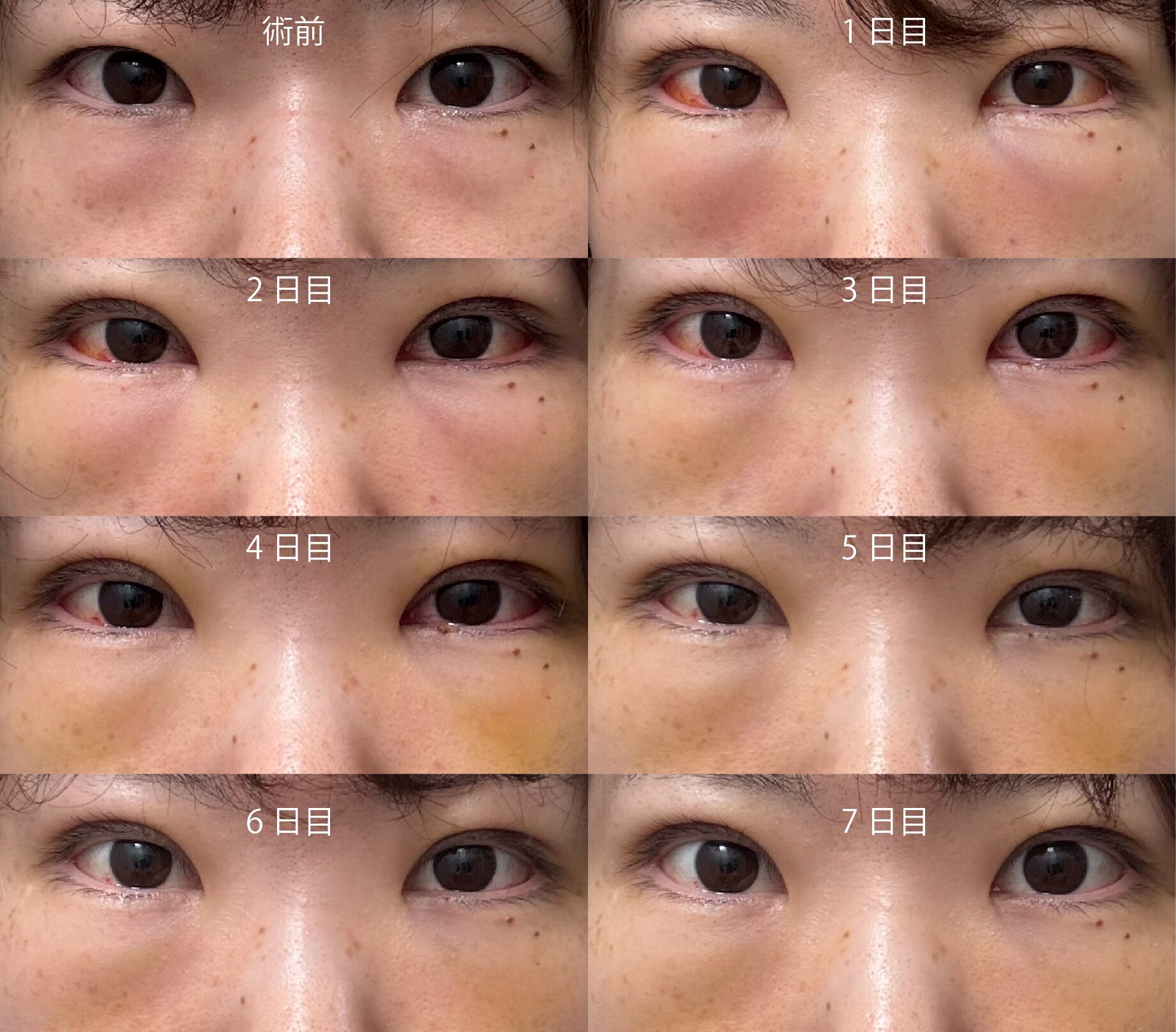 30代女性のダウンタイム<br />
